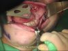 Mandible Angle-Splitting Osteotomy