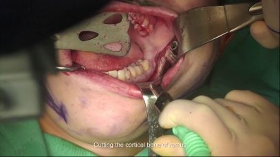 Mandible Angle-Splitting Osteotomy