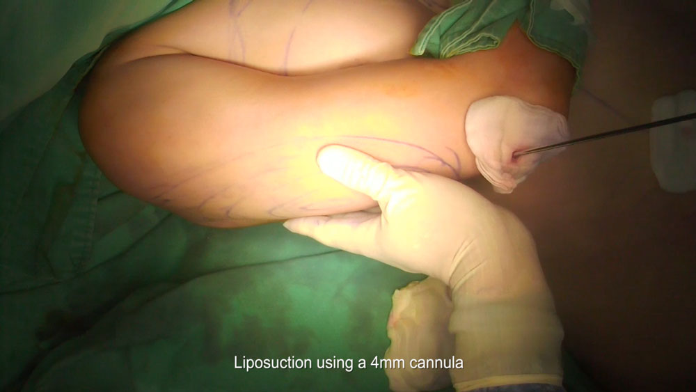 Video17_Ultrasonic-Liposuction-of-Arms_Pic