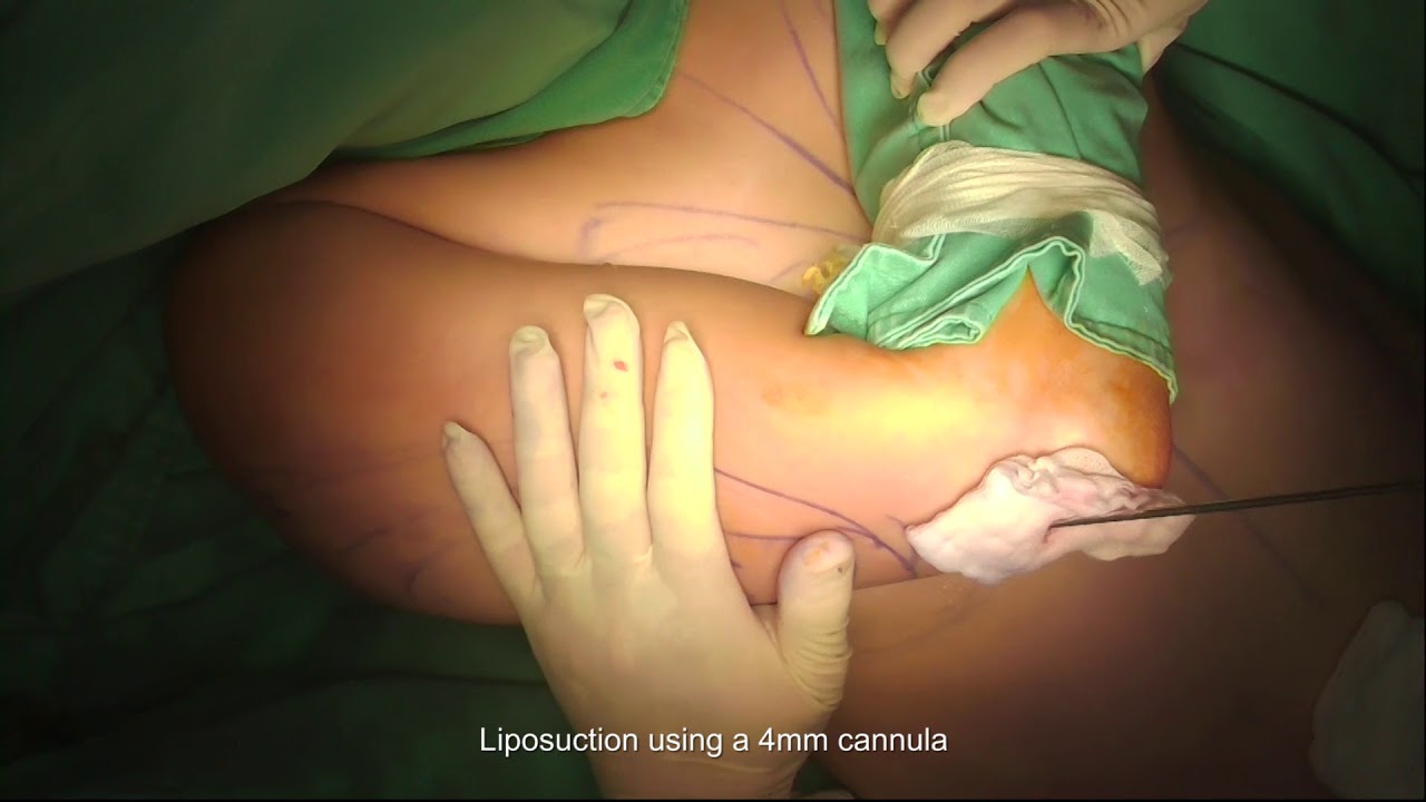 Ultrasonic Liposuction of Arms