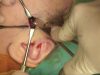 Video20_Zygomatic-Body-and-Arch-Reduction_Pic