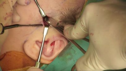 Video20_Zygomatic-Body-and-Arch-Reduction_Pic