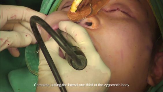Zygomatic Body and Arch Reduction