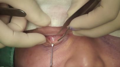 Video22_Trans-Conjunctival-Eye-Bag-Removal