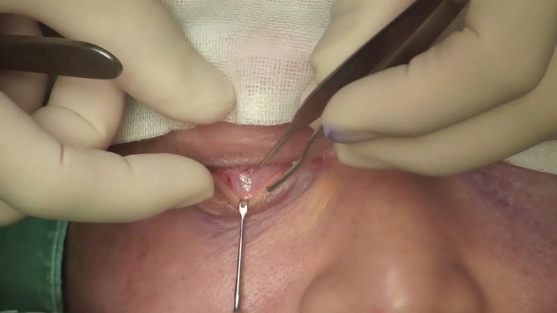 Video22_Trans-Conjunctival-Eye-Bag-Removal