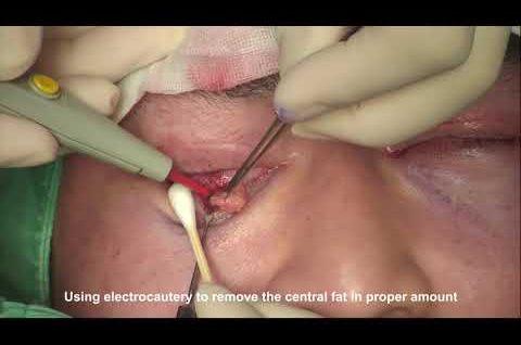 Trans-Conjunctival Eye Bag Removal