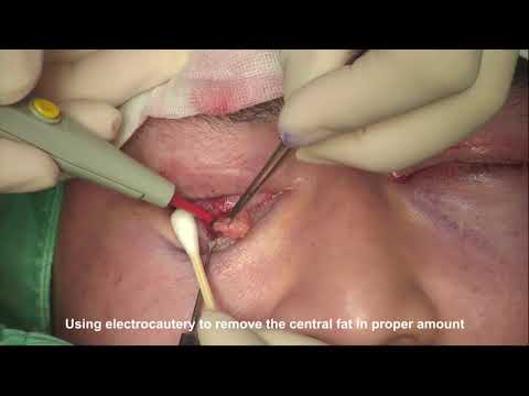 Trans-Conjunctival Eye Bag Removal